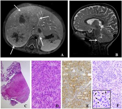 Epstein–Barr Virus+ Smooth Muscle Tumors as Manifestation of Primary Immunodeficiency Disorders